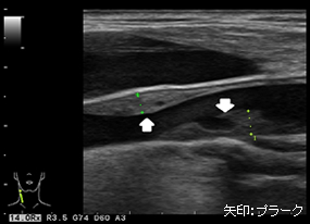 動脈硬化が進行した頸動脈